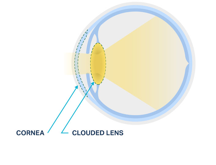 Diagram of a normal lens versus a cloudy lens from an eye cataract