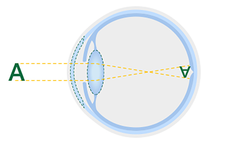 Diagram of a healthy lens