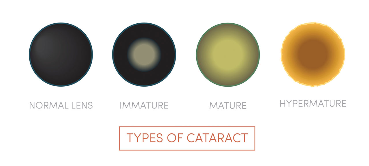 Types of cataract: normal lens, immature, mature, hypermature